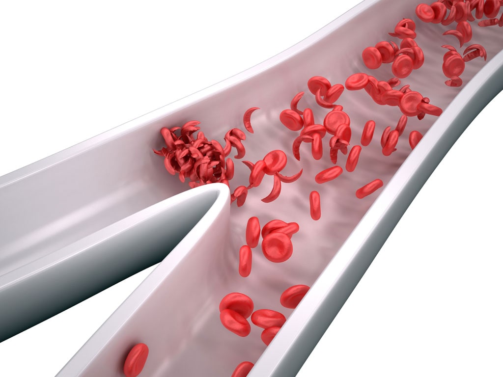 New York Man Becomes First in State to Be Cured of Sickle Cell Anemia with Gene Therapy