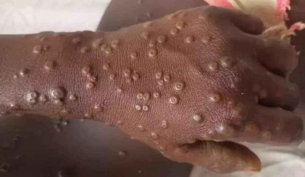 Africa Needs Over $220 Million to Strengthen Mpox Response Amid Rising Cases Across the Continent